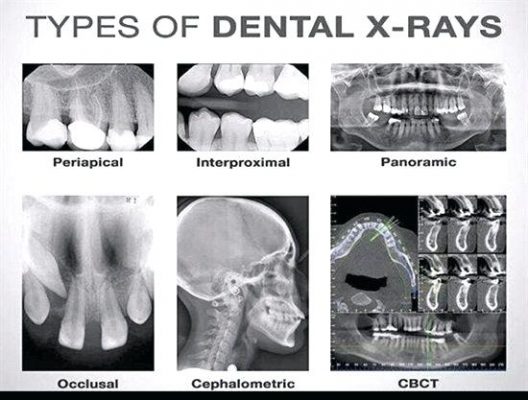 Different Types Of X-Rays