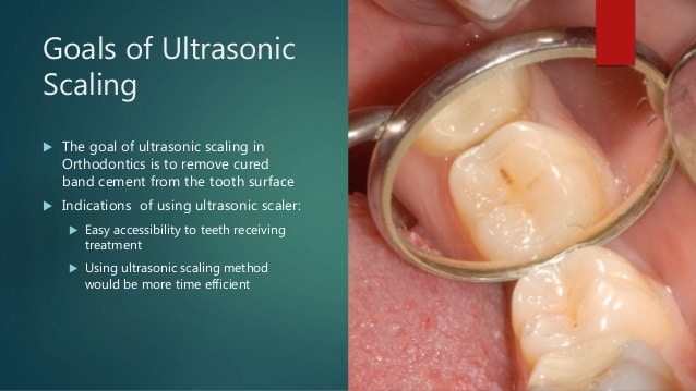 ultrasonic scalers dentistry